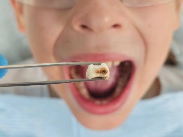 Best Knocked-Out Tooth Emergency  in Oakwood, OH